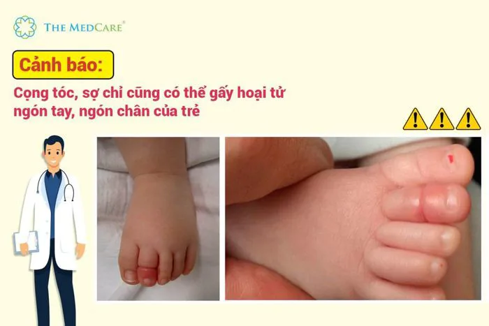 Cọng tóc, sợi chỉ cũng có thể gây hoại tử ngón tay, ngón chân của trẻ - The  MedCare Hải Phòng