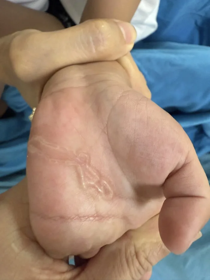 Bàn tay bé trai xuất hiện dấu hiệu lạ sau lần nghịch cát - Báo Người Lao  Động