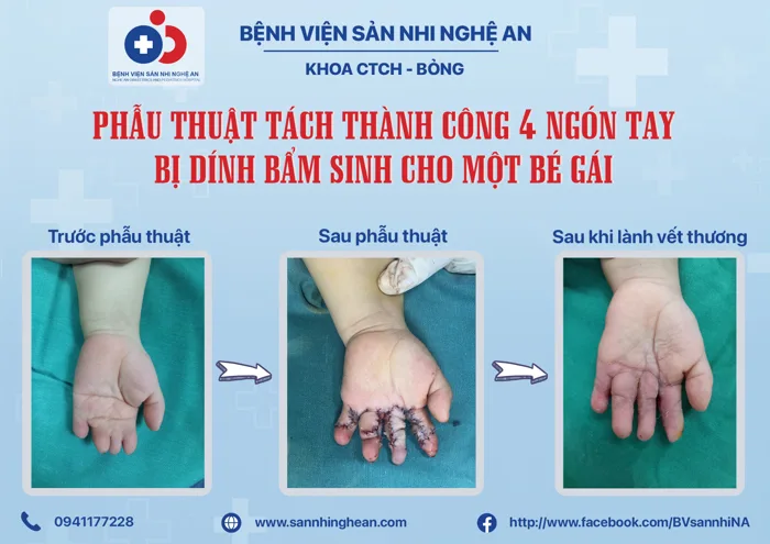 Phẫu thuật tách thành công 4 ngón tay bị dính bẩm sinh cho trẻ | Tin tức