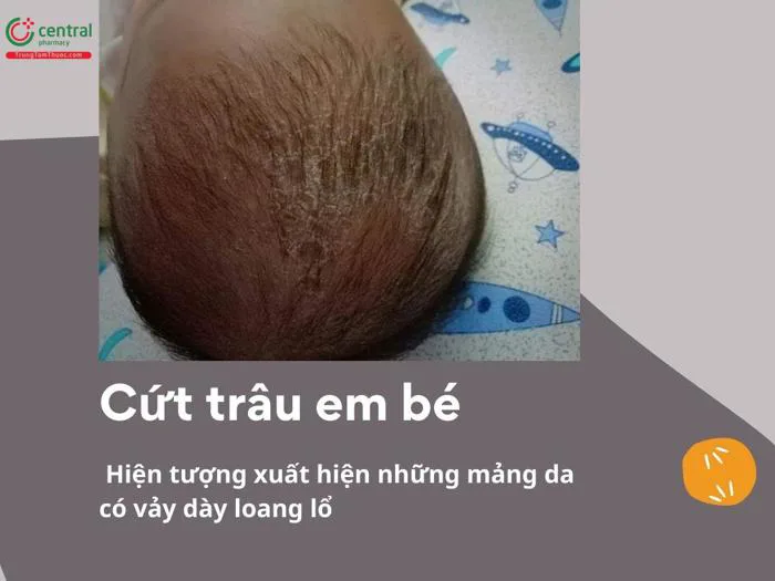 Cứt trâu (viêm da tiết bã) em bé là gì? Cách trị cứt trâu cho trẻ sơ sinh