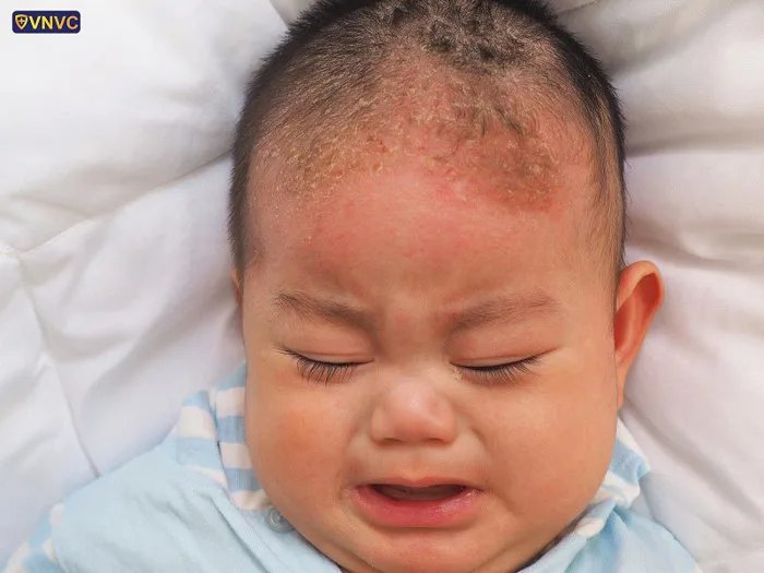 Viêm da tiết bã: nguyên nhân, triệu chứng, điều trị và cách phòng ngừa -  Công ty Cổ phần Vacxin Việt Nam