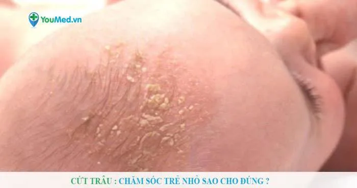 Cứt trâu: Chăm sóc trẻ nhỏ sao cho đúng ?