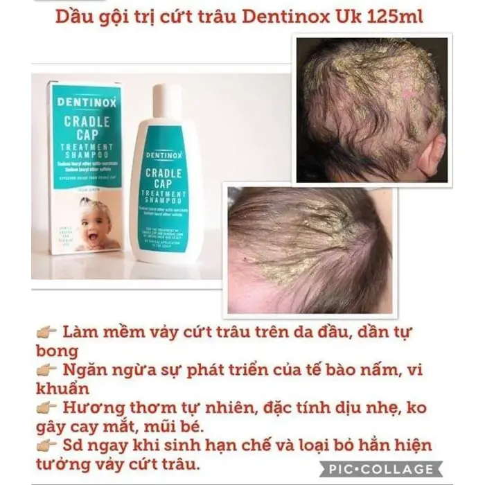 Dầu Gội Trị Cứt Trâu Dầu Gội Trị Viêm Da Tiết Bã Dentinox Cho Bé (Hàng Air  Anh) Dầu Gội Tái Tạo Da Đầu Cho Bé 0-3 Tháng - Lazada | Lazada Việt Nam