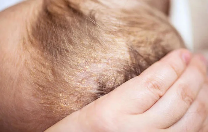 Bác sỹ mách mẹ cách chữa 