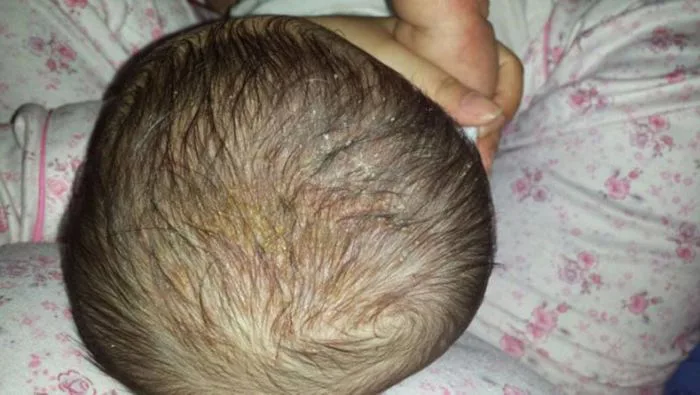 Cách trị cứt trâu ở trẻ sơ sinh (viêm da tiết bã) đơn giản - MarryBaby