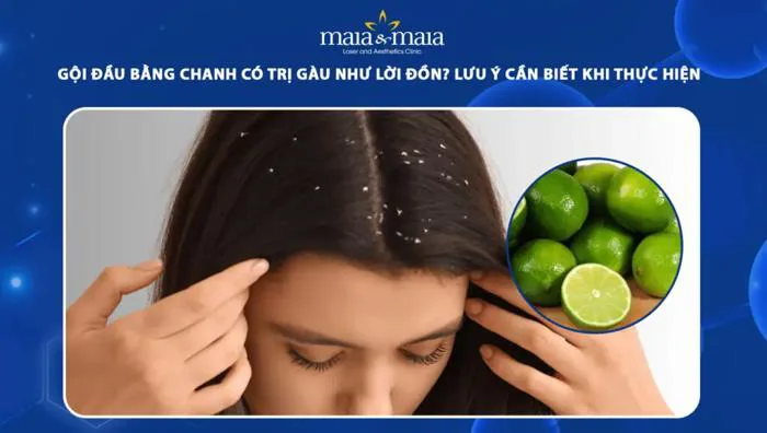 Gội đầu bằng chanh có trị gàu như lời đồn? Lưu ý cần biết