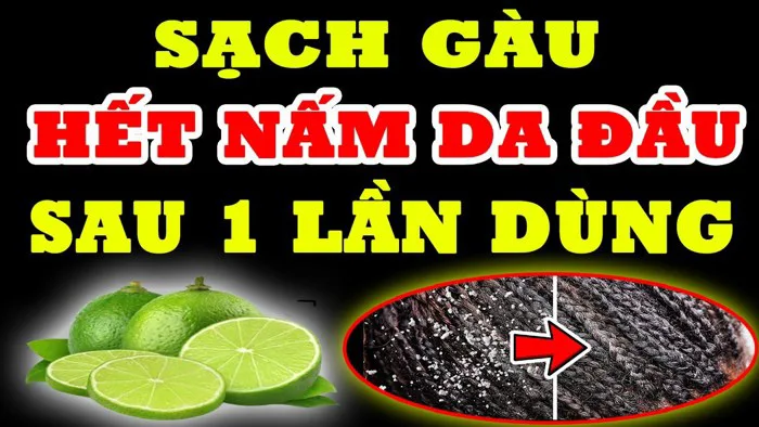 Trị Gàu Nấm Da Đầu Cỡ Mấy Cũng Hết Ngay Lập Tức, Chỉ Với Tuyệt Chiêu Đơn  Giản SAU MỘT LẦN THỰC HIỆN