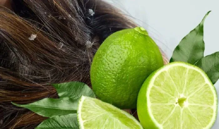 Gợi ý cách trị nấm da đầu bằng chanh tại nhà hiệu quả, tiết kiệm –  Biocarepharma