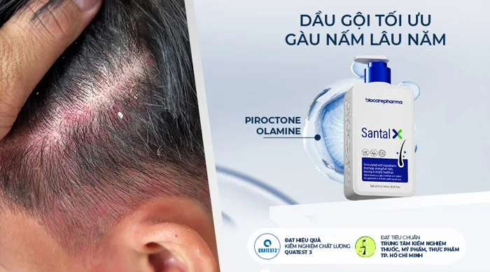 Gợi ý cách trị nấm da đầu bằng chanh tại nhà hiệu quả, tiết kiệm –  Biocarepharma