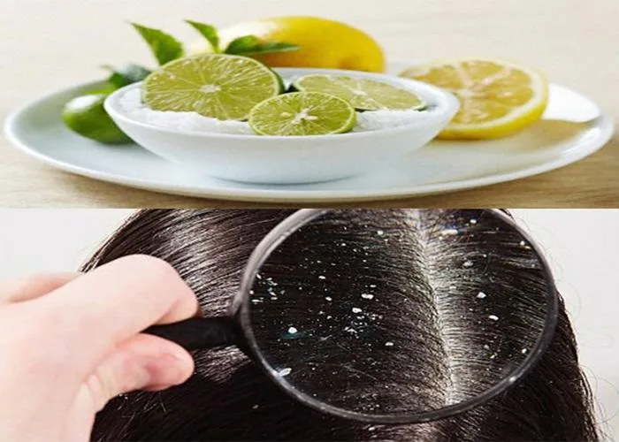 7 cách trị nấm da đầu bằng phương pháp tự nhiên hiệu quả - iCare Pharma