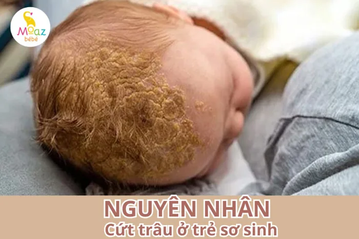 Cứt trâu ở trẻ sơ sinh là gì? Những mẹo trị cứt trâu hiệu quả