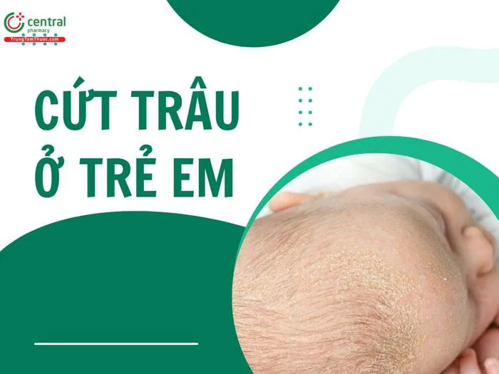 Cứt trâu (viêm da tiết bã) em bé là gì? Cách trị cứt trâu cho trẻ sơ sinh