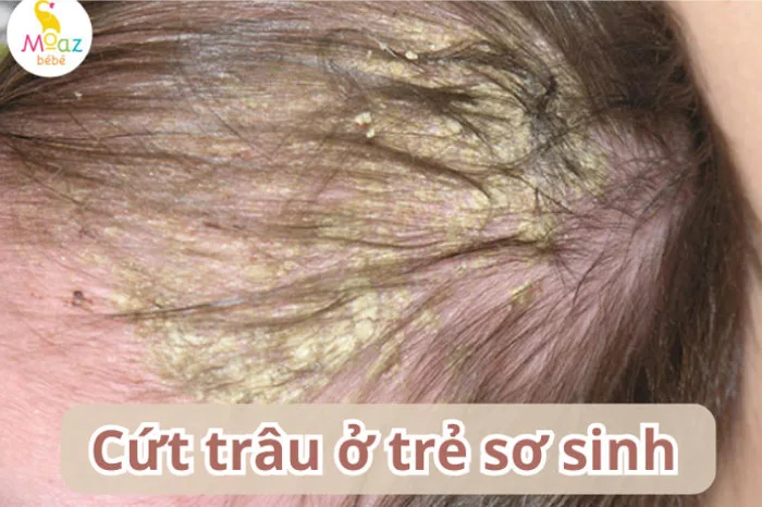 Cứt trâu ở trẻ sơ sinh là gì? Những mẹo trị cứt trâu hiệu quả