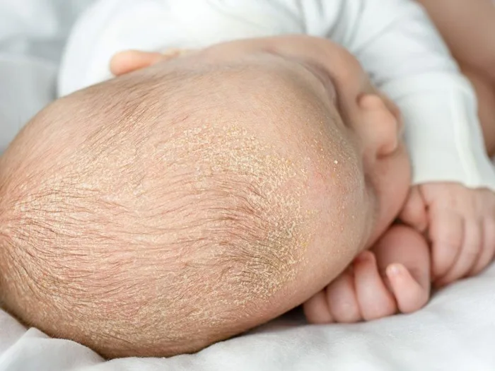 Bật mí những mẹo trị cứt trâu ở trẻ sơ sinh hiệu quả - Nhà thuốc FPT Long  Châu