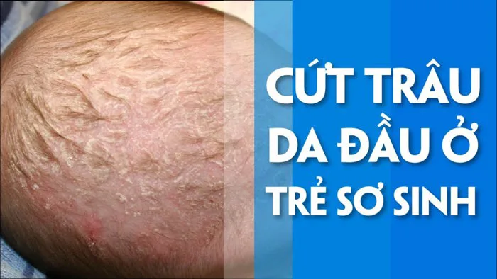 Cứt trâu trên đầu trẻ: Nguyên nhân và cách trị dứt điểm