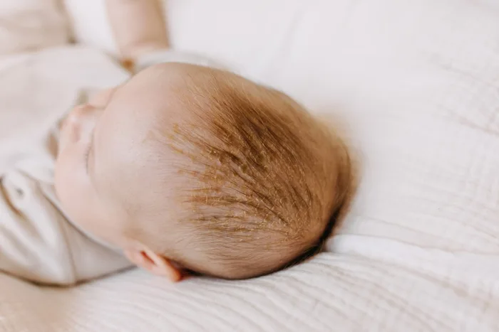 Cách trị cứt trâu ở trẻ sơ sinh (viêm da tiết bã) đơn giản - MarryBaby