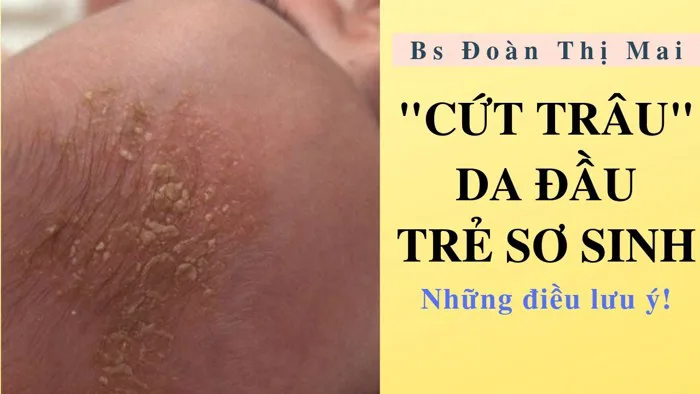 Cứt Trâu da đầu trẻ sơ sinh: Xử lý thế nào? | Bác Sĩ Đoàn Thị Mai