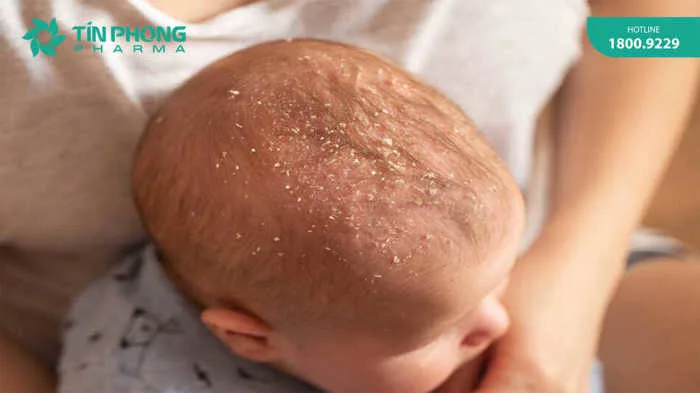 3 cách trị cứt trâu cho trẻ sơ sinh được chuyên gia tin tưởng nhất