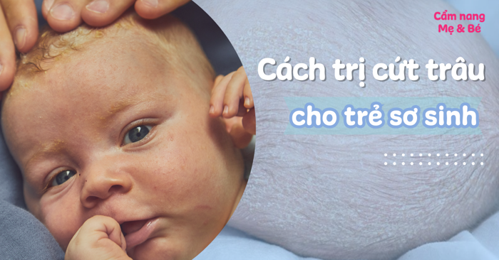 Cứt trâu ở trẻ sơ sinh (viêm da tiết bã): Nguyên nhân, cách điều trị