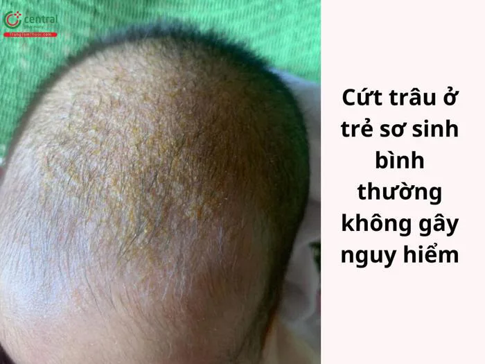 Cứt trâu (viêm da tiết bã) em bé là gì? Cách trị cứt trâu cho trẻ sơ sinh