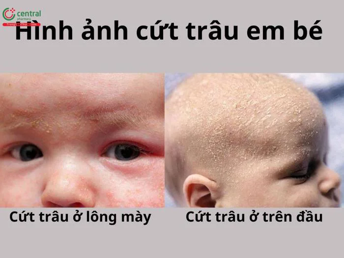 Cứt trâu (viêm da tiết bã) em bé là gì? Cách trị cứt trâu cho trẻ sơ sinh
