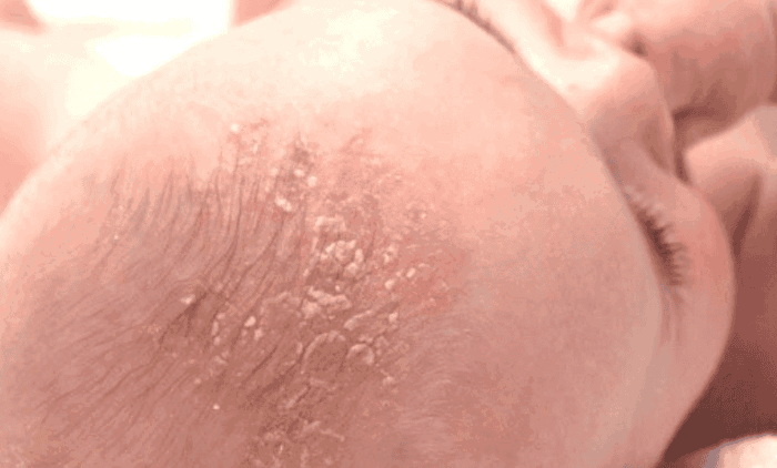 Viêm da tiết bã (cứt trâu trên đầu trẻ sơ sinh): Những điều cần biết | Vinmec Viêm da tiết bã (cứt trâu trên đầu trẻ sơ sinh): Những điều cần biết | Vinmec