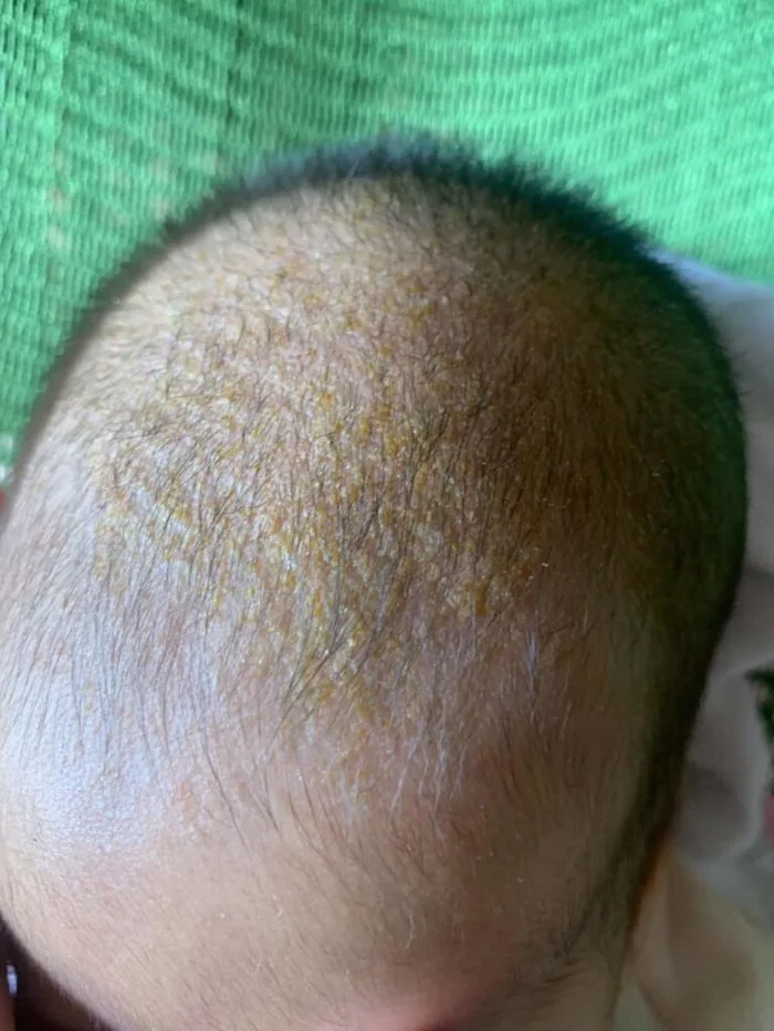 Cách trị cứt trâu cho trẻ sơ sinh - Bluecare Blog Cách trị cứt trâu cho trẻ sơ sinh - Bluecare Blog