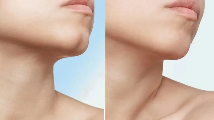 Cằm chẻ là gì? Ý nghĩa tướng số nam nữ và cách tạo cằm chẻ tự nhiên