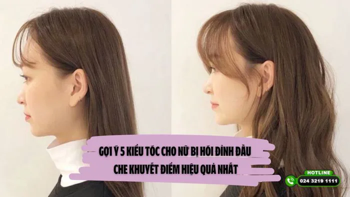 Gợi ý 5 kiểu tóc cho nữ bị hói đỉnh đầu che khuyết điểm hiệu quả - Viện Cấy  Tóc Quốc Tế