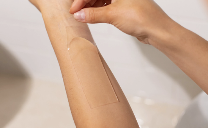 Miếng dán Silicone Y tế và Steroid trị sẹo lồi, nên dùng loại nào?