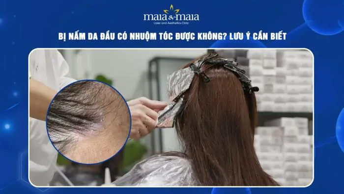 Bị nấm da đầu có nhuộm tóc được không? Lưu ý cần biết