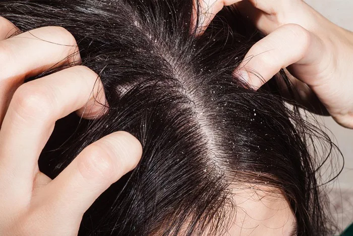 Nhuộm tóc xong bị ngứa da đầu là do đâu? Cách khắc phục | Yody