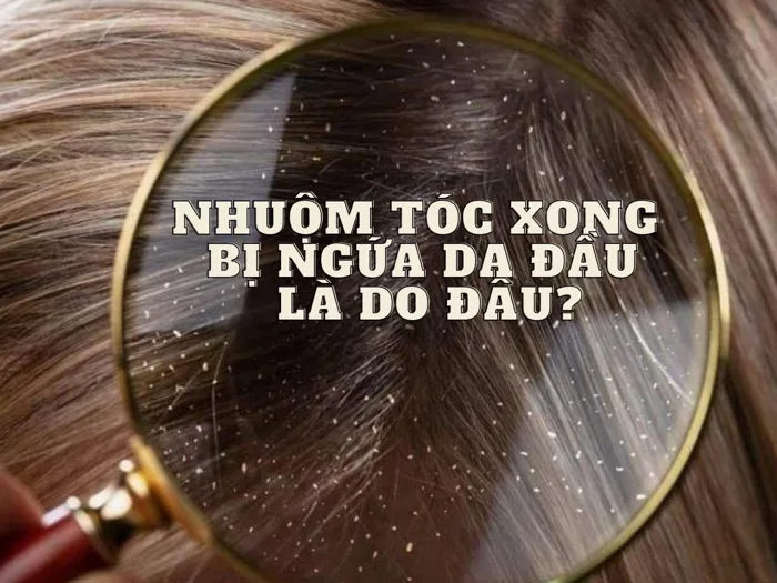 Nhuộm tóc xong bị ngứa da đầu là do đâu? Cách khắc phục | Yody