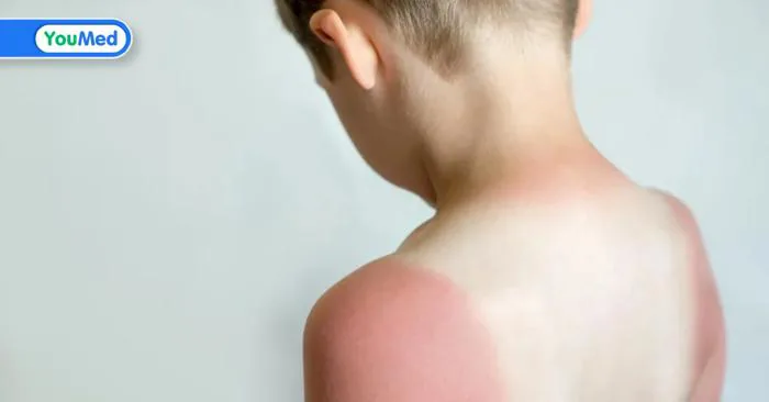 Da bé bị cháy nắng: Cha mẹ cần phải làm gì?