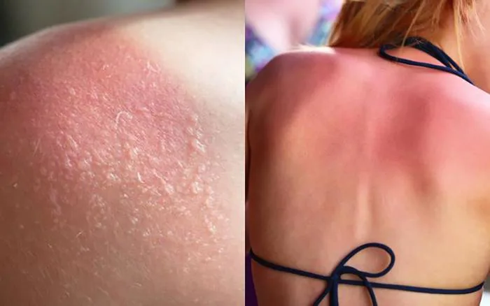 Giải cứu' làn da bị cháy nắng, mẩn đỏ sau khi đi nắng
