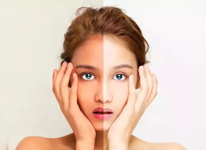 Cách chữa da cháy nắng hiệu quả nhất tại nhà