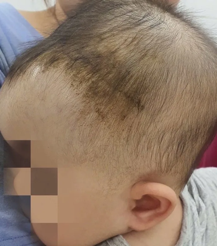 Bé 7 tháng tuổi tụ máu dưới da đầu từ cú ngã tưởng như vô hại