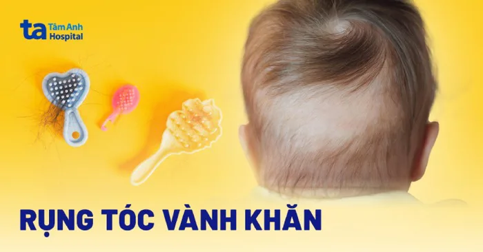 Rụng tóc vành khăn ở trẻ: Nguyên nhân, dấu hiệu, điều trị, phòng ngừa