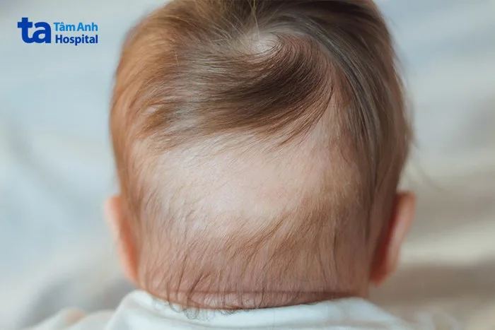 Rụng tóc vành khăn ở trẻ: Nguyên nhân, dấu hiệu, điều trị, phòng ngừa