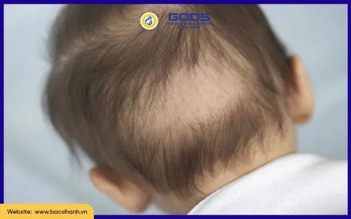 Trẻ chậm mọc tóc thiếu chất gì và cách bổ sung hiệu quả