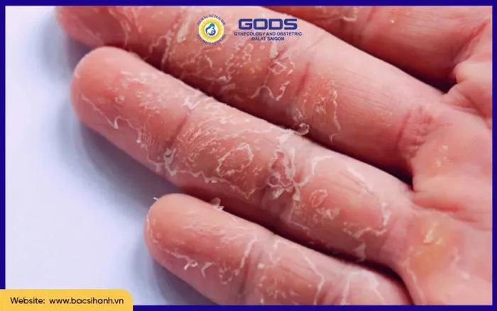 Tróc da đầu ngón tay thiếu chất gì? Vi chất - Bác Sĩ Hạnh