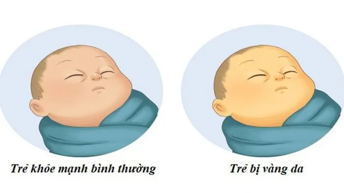 Vàng da ở trẻ sơ sinh: Dấu hiệu cảnh báo bệnh lý | Vinmec