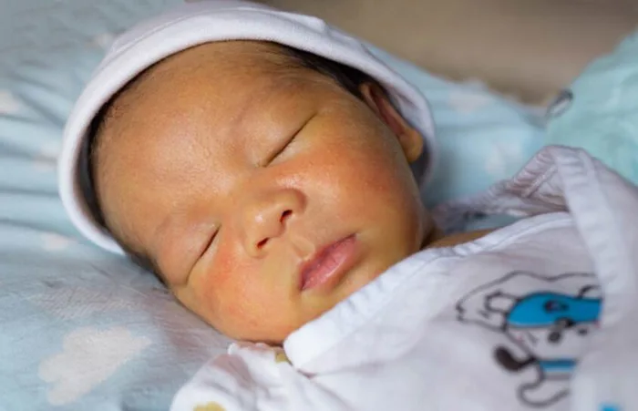 Vàng da ở trẻ sơ sinh: Nguyên nhân, dấu hiệu và cách điều trị hiệu quả