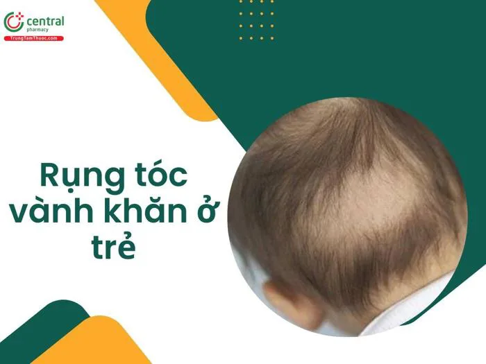 Dấu hiệu rụng tóc vành khăn ở trẻ. Rụng tóc vành khăn có nguy hiểm không?