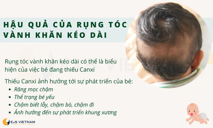 Bật mí cách chữa rụng tóc vành khăn siêu dễ cho bé chỉ sau 7 ngày!