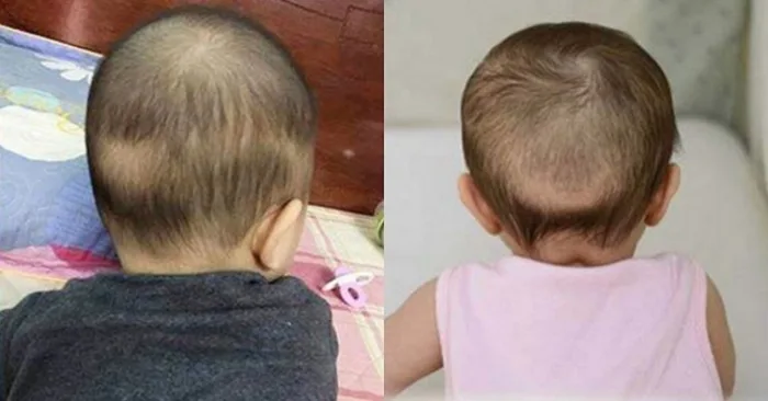 Trẻ bị rụng tóc vành khăn nên bổ sung gì? Rụng tóc có bị còi xương không?