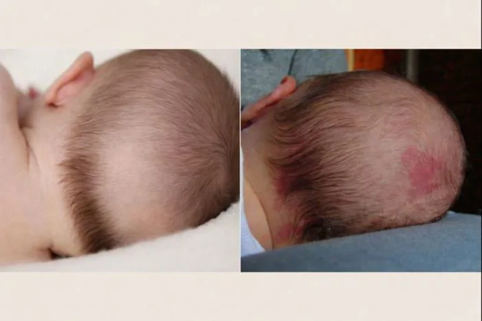 Trẻ bị rụng tóc vành khăn: Sự thật mẹ cần biết ngay!