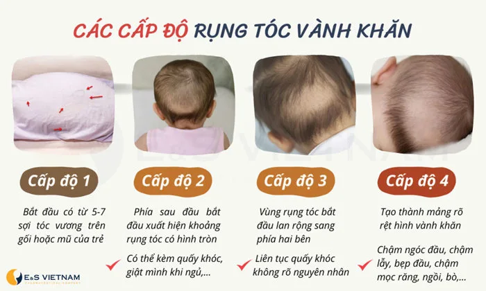 Bật mí cách chữa rụng tóc vành khăn siêu dễ cho bé chỉ sau 7 ngày!