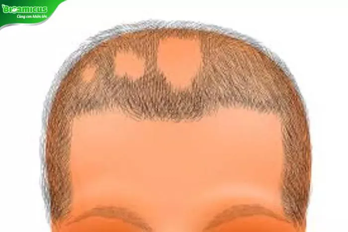 Trẻ sơ sinh bị rụng tóc: 4 kiểu rụng tóc