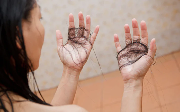 Trẻ bị rụng tóc vành khăn có đáng lo ngại?